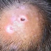 Primera muerte por miasis, se registra en el estado de Campeche