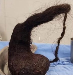 El doctor David Canché, pediatra y cirujano encargado del procedimiento, explicó que la menor presentaba antecedentes de ansiedad, lo que la llevaba a morderse y tragarse su propio cabello