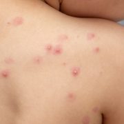 OMS alerta sobre contagio masivo de viruela del mono