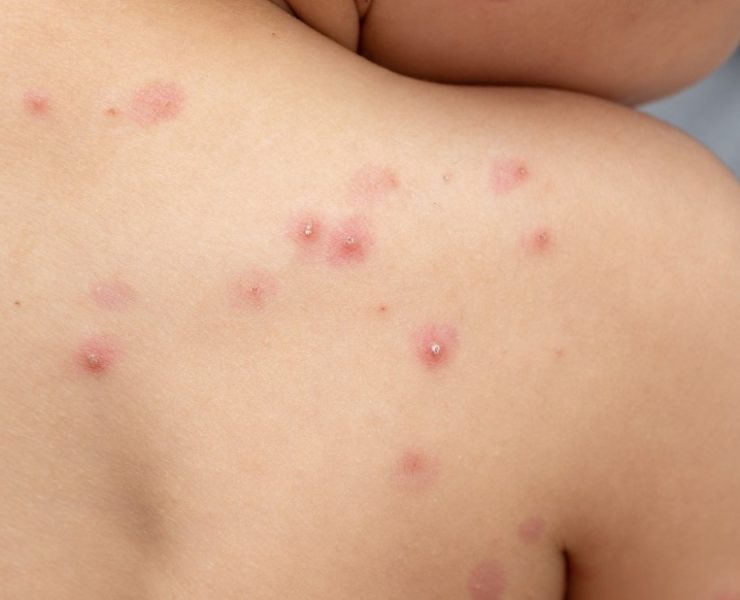 OMS alerta sobre contagio masivo de viruela del mono