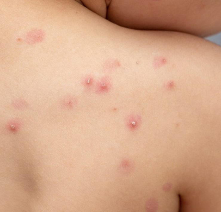 OMS alerta sobre contagio masivo de viruela del mono