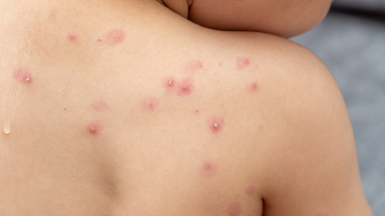 OMS alerta sobre contagio masivo de viruela del mono