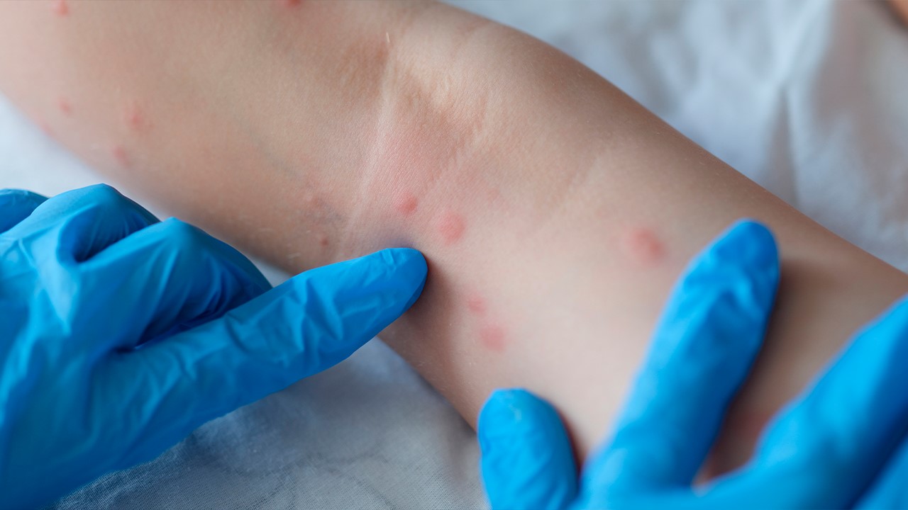 Qué es la viruela del mono y cómo se propaga