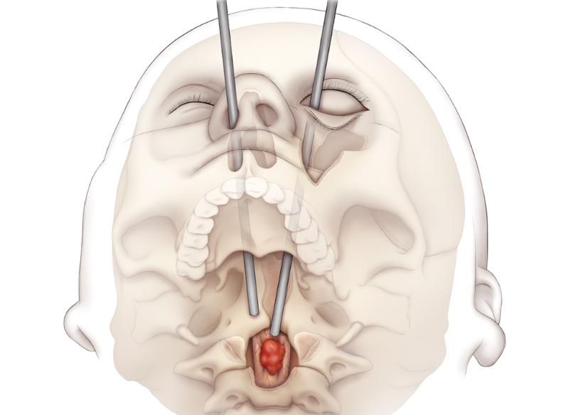 ¿Cómo es posible que cirujanos extirpen un tumor espinal por el ojo?