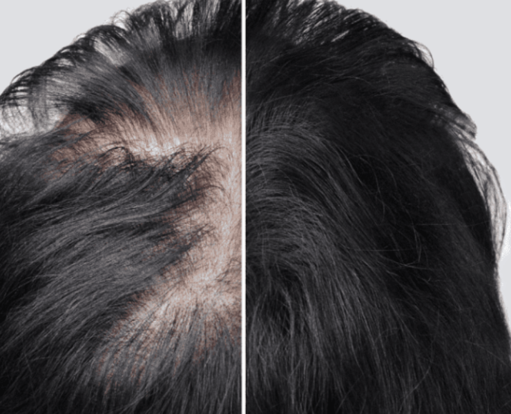 Una proteína podría curar la calvicie según científicos de la UCLA
