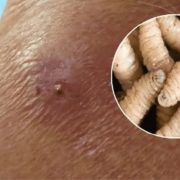 ¡Alerta en Yucatán! Detectan primera persona infectada por gusano barrenador en Yucatán