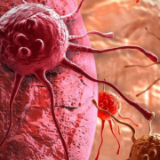 Una nueva forma de destruir el cáncer de próstata está siendo evaluada por expertos