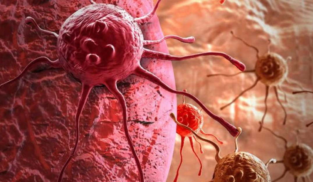 Una nueva forma de destruir el cáncer de próstata está siendo evaluada por expertos