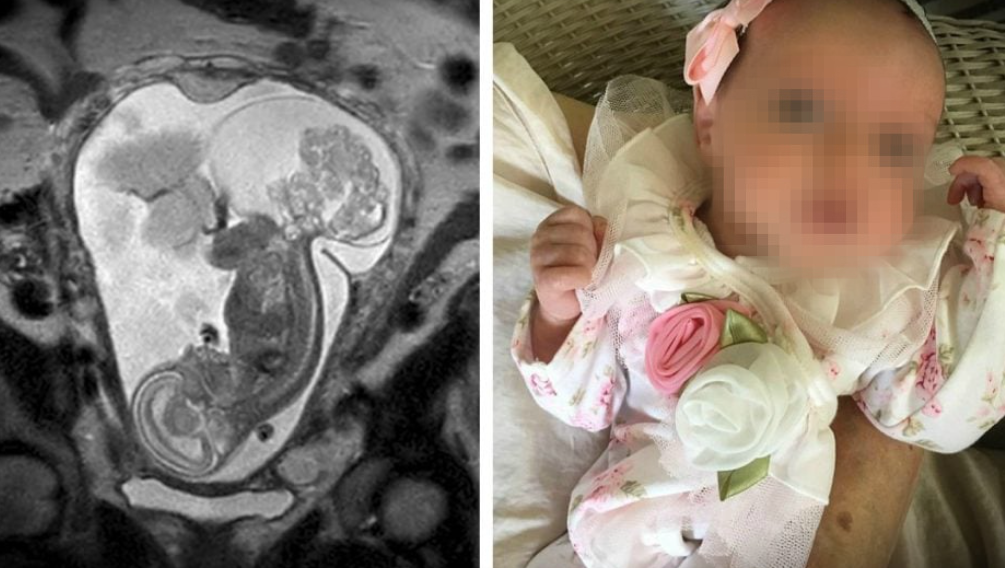 Hacia lo imposible: cirugía fetal abierta en el Texas Children’s Hospital