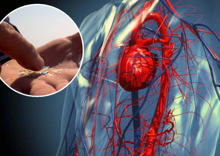 Microplásticos causan accidentes cardiovasculares ya que están en nuestro cuerpo