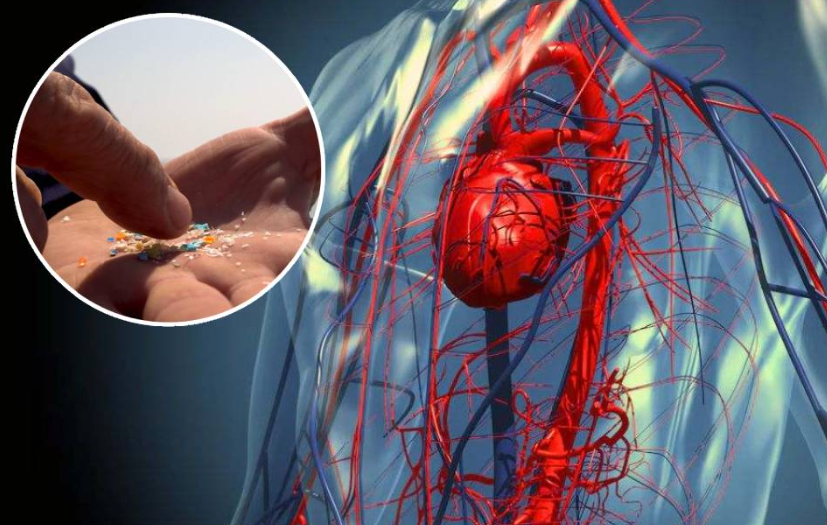 Microplásticos causan accidentes cardiovasculares ya que están en nuestro cuerpo