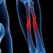 Crean pegamento para huesos que repara fracturas en cuestión de minutos