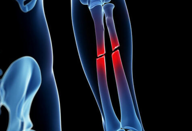 Crean pegamento para huesos que repara fracturas en cuestión de minutos