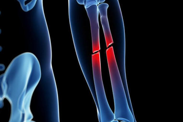 Crean pegamento para huesos que repara fracturas en cuestión de minutos