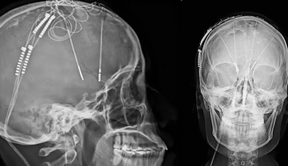 ¿En qué consistió la primera cirugía cerebral para la depresión?