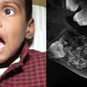 Descubren a un niño con 526 dientes y los médicos quedan impactados
