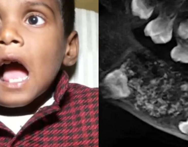 Descubren a un niño con 526 dientes y los médicos quedan impactados