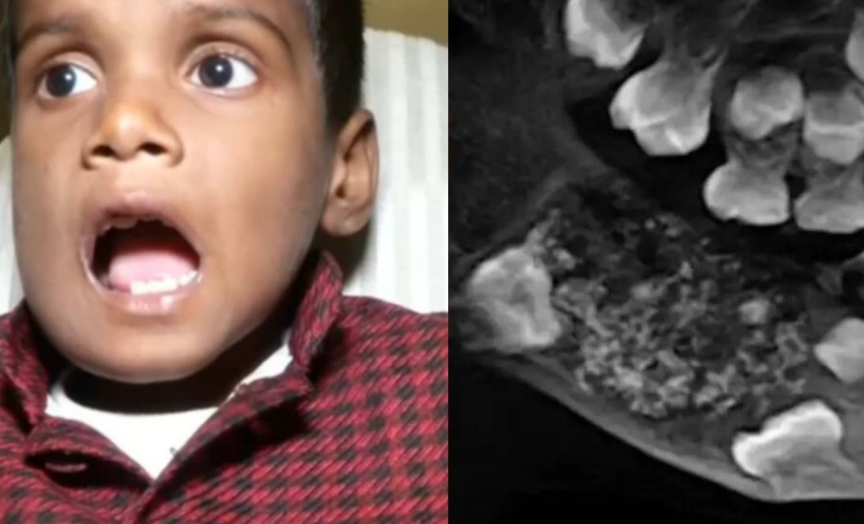 Descubren a un niño con 526 dientes y los médicos quedan impactados