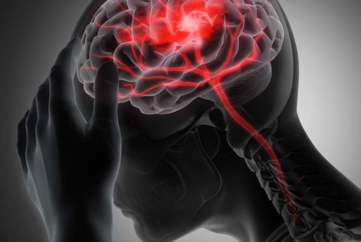 Científicos revierten el daño cerebral causado por un accidente cardio vascular