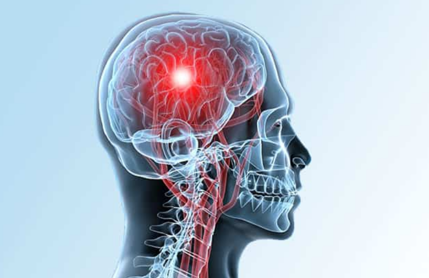 ¿Qué es un accidente cerebrovascular y por qué es tan devastador?
