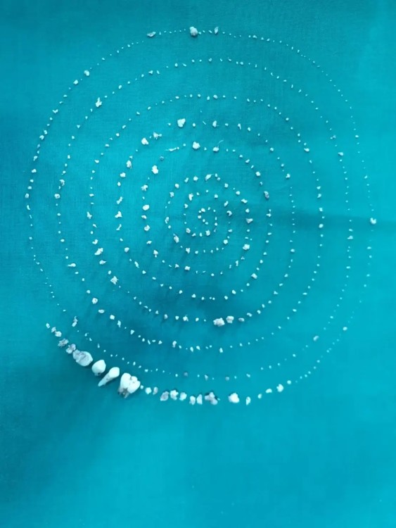 Cirugía para extraer cientos de dientes en una sola operación