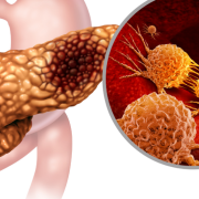 Usan la gripe contra el cáncer de páncreas, la ciencia no conoce limites