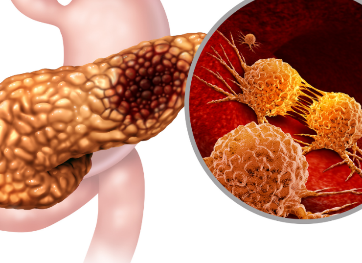 Usan la gripe contra el cáncer de páncreas, la ciencia no conoce limites