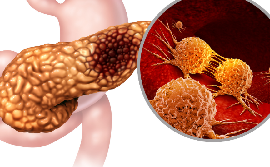 Usan la gripe contra el cáncer de páncreas, la ciencia no conoce limites