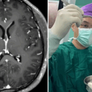 Hombre descubre un parasito en su cerebro por que "veía en mosaico"