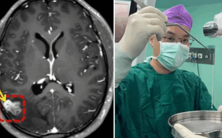 Hombre descubre un parasito en su cerebro por que "veía en mosaico"