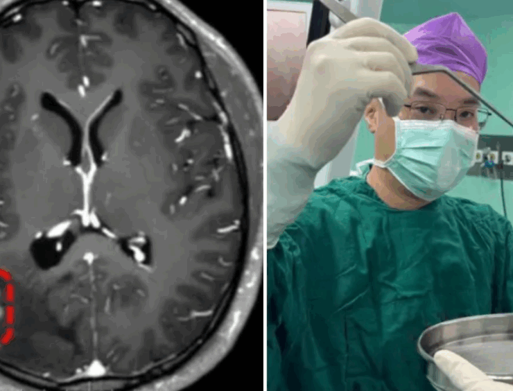 Hombre descubre un parasito en su cerebro por que "veía en mosaico"