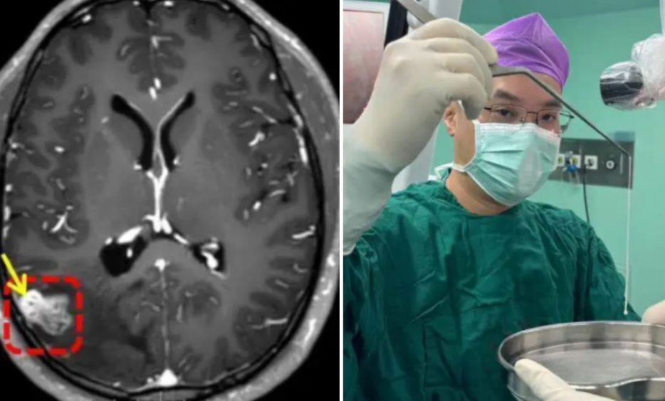 Hombre descubre un parasito en su cerebro por que "veía en mosaico"