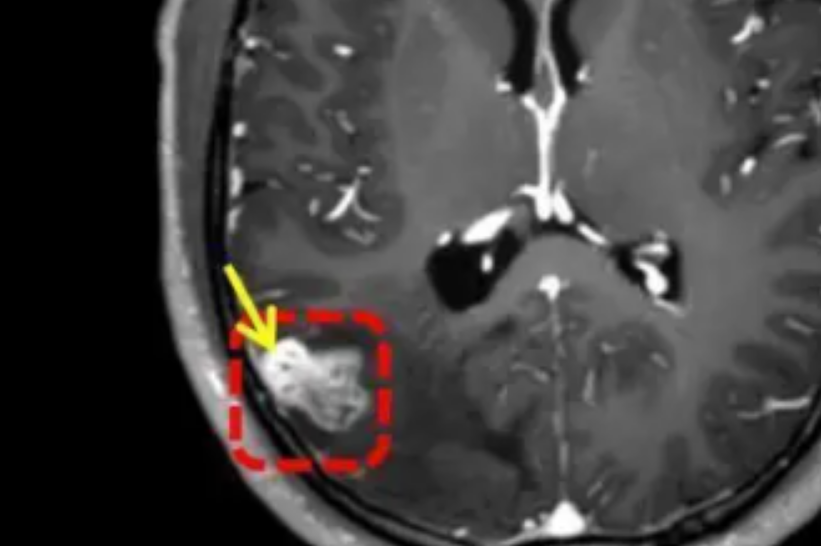 Síntomas iniciales y evolución del parásito