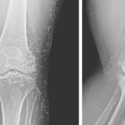 Mujer tenía "Hilos dorados" en las rodillas y se dio cuenta por el dolor