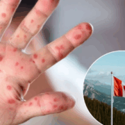 Canadá "pierde" ante el sarampión, se presento un caso después de 30 años limpios