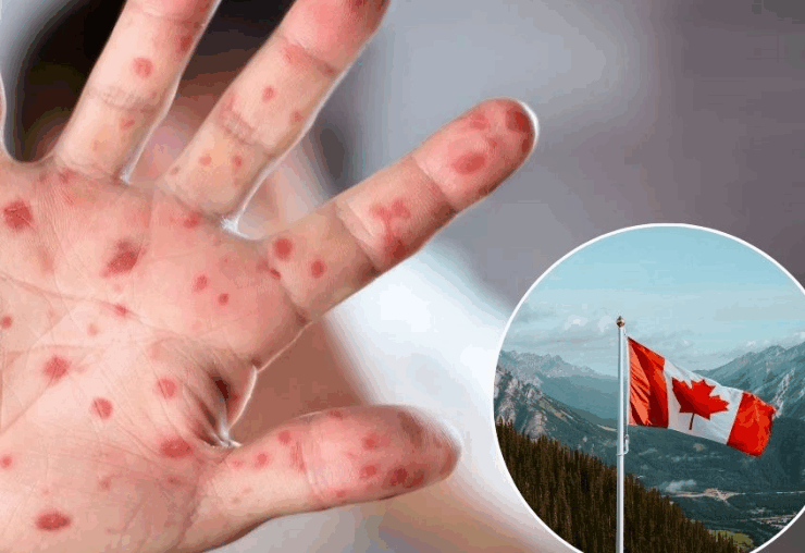 Canadá "pierde" ante el sarampión, se presento un caso después de 30 años limpios