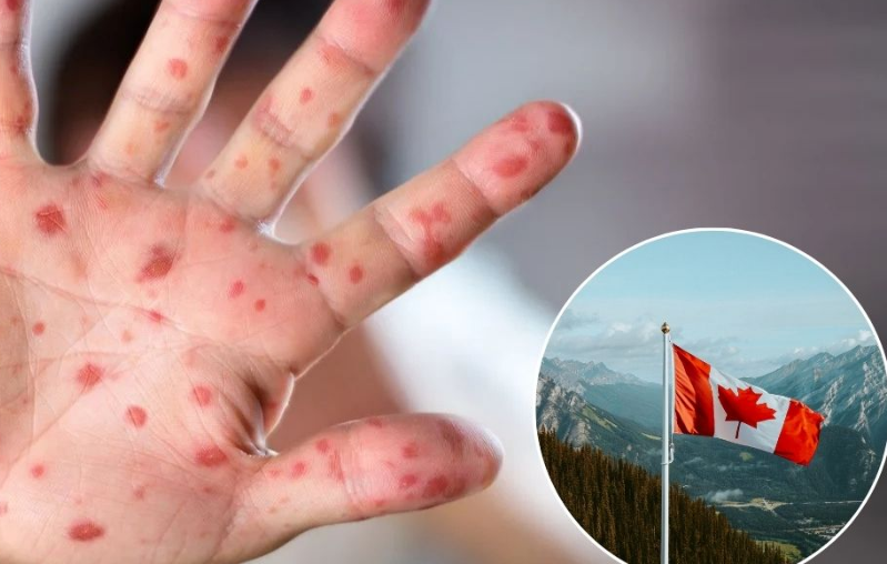 Canadá "pierde" ante el sarampión, se presento un caso después de 30 años limpios