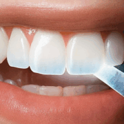 Crean un gel que hace "crecer" el esmalte gastado de los dientes