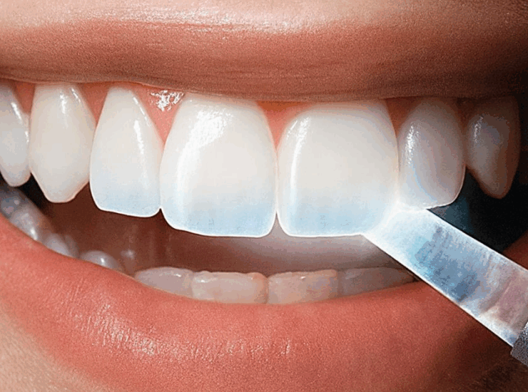 Crean un gel que hace "crecer" el esmalte gastado de los dientes