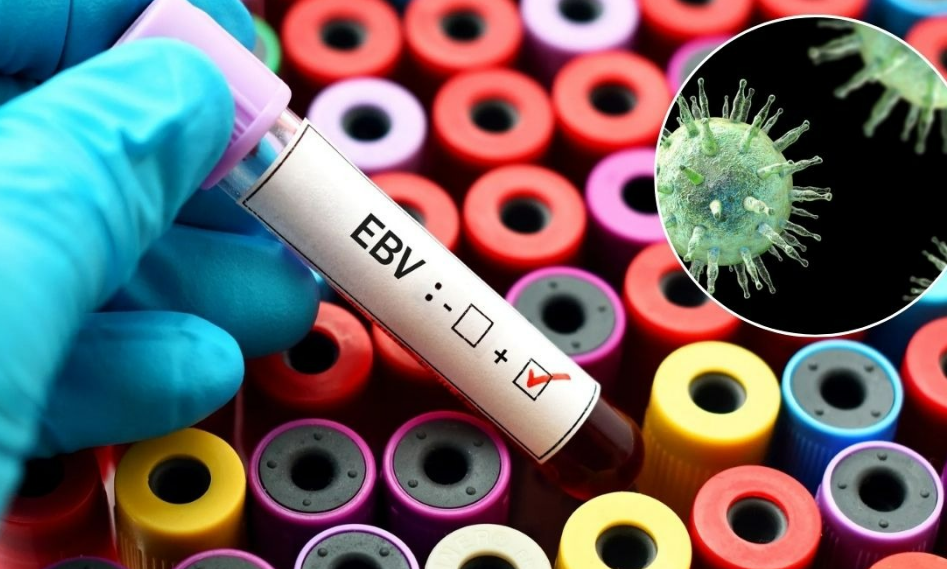 El papel del virus Epstein-Barr en el lupus