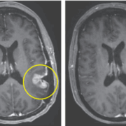 Nuevo tratamiento contra el cáncer ayudó a mujer en tan solo 5 días