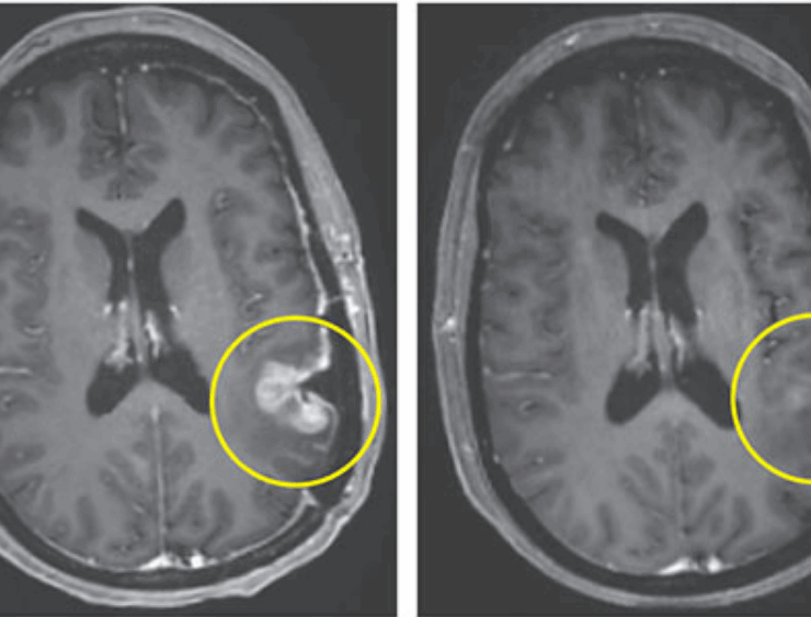 Nuevo tratamiento contra el cáncer ayudó a mujer en tan solo 5 días