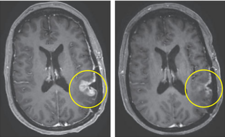 Nuevo tratamiento contra el cáncer ayudó a mujer en tan solo 5 días