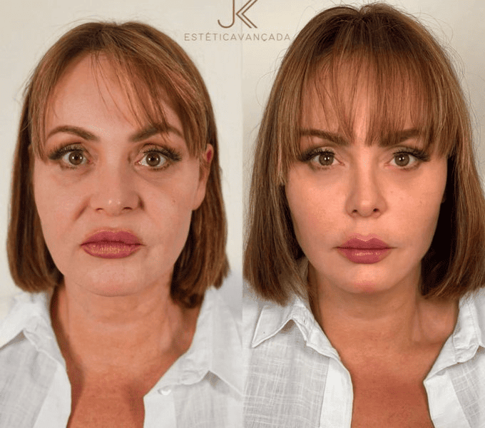 Procedimientos aplicados a Gaby Spanic