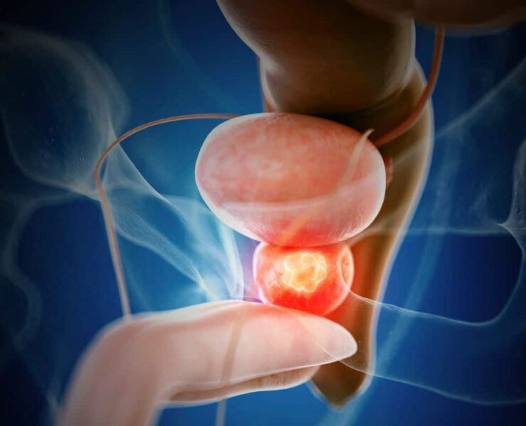 Movember 2025: Urgencia silenciosa en la salud masculina; el testimonio de José revela por qué la detección temprana del cáncer de próstata es vital