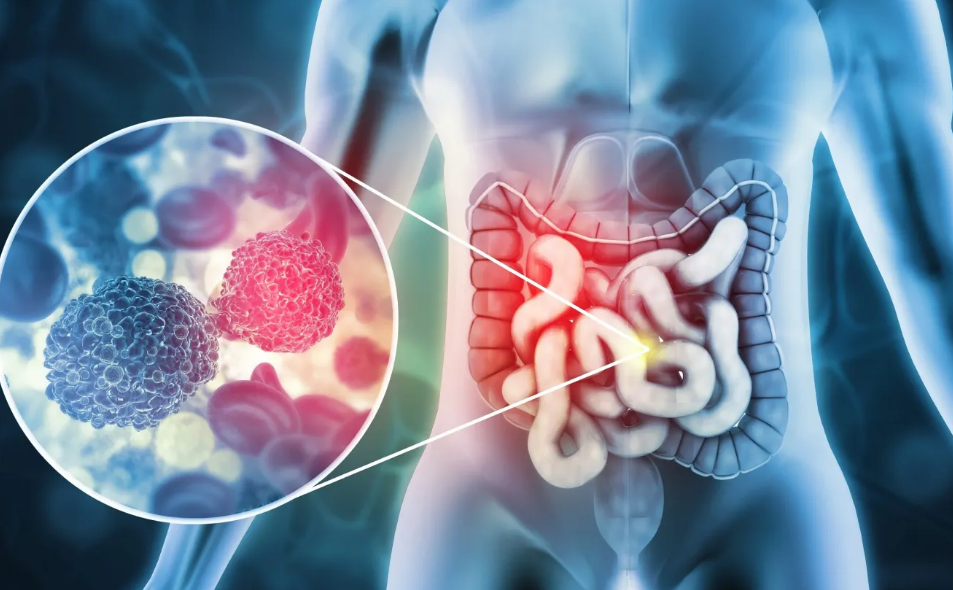 ¿Por qué el estudio demuestra aumento de cáncer de colon en adultos jóvenes?