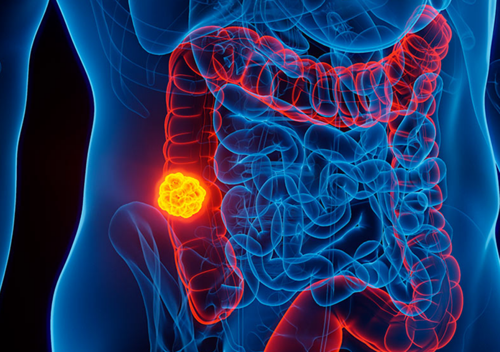 Detección temprana: La clave en la lucha contra el cáncer de colon