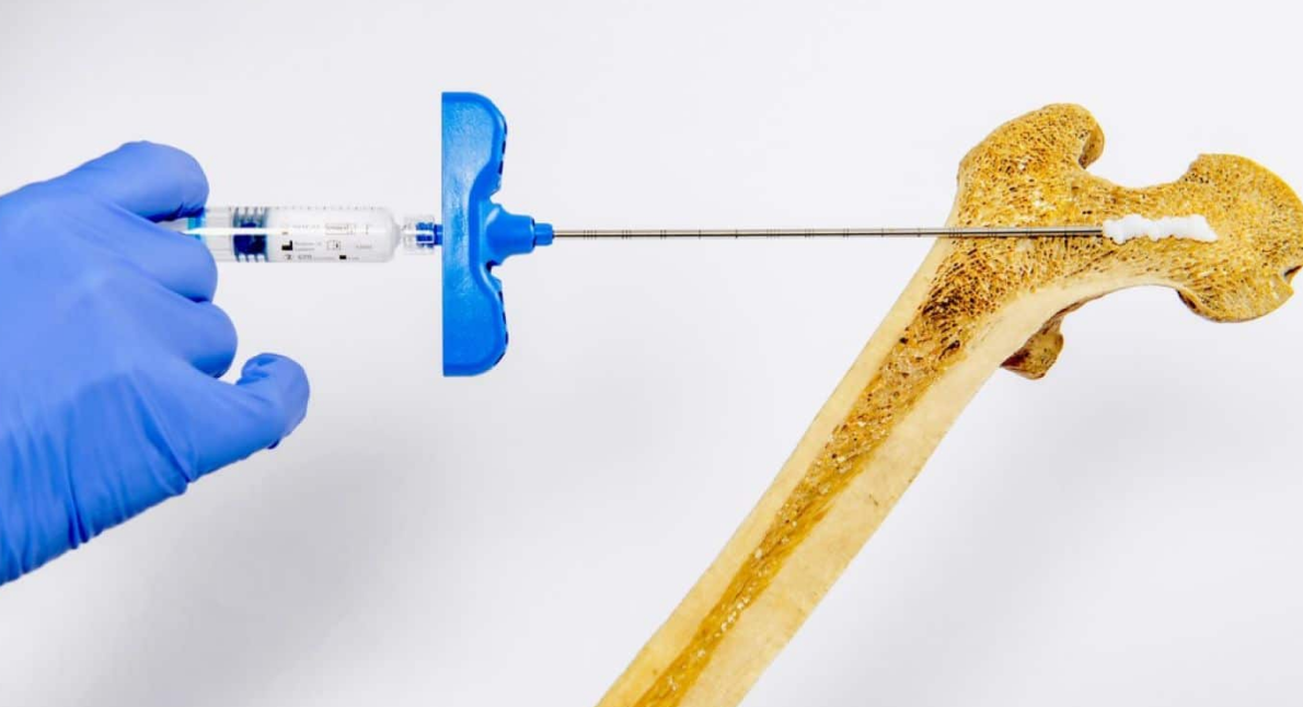 Inyecciones de hidrogel: un avance revolucionario