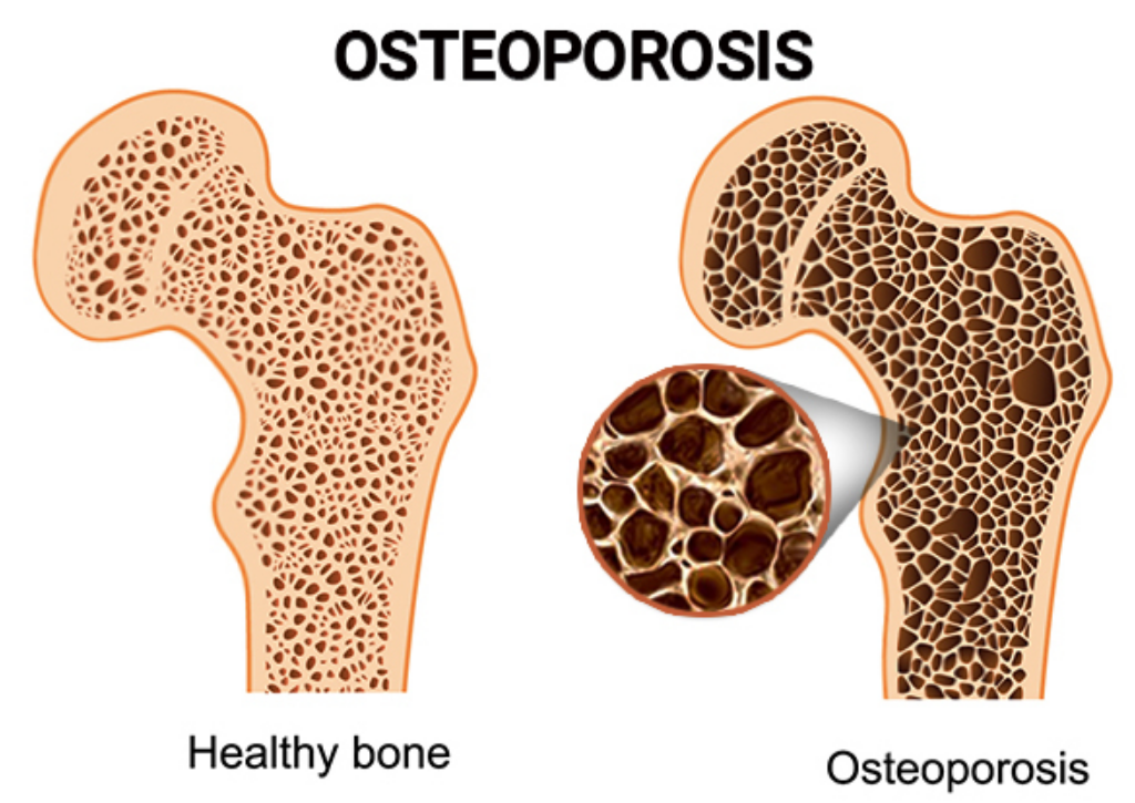 Impacto de la osteoporosis en la salud