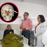 Histórica cirugía en Yucatán: IMSS salva a joven con una coa incrustada en la cabeza